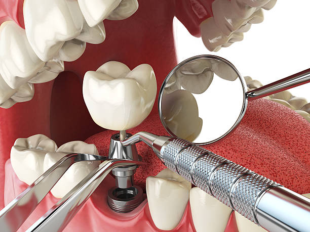 Best Emergency Dentist for Knocked-Out Tooth in Country Clu, MO